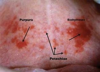 petachiae