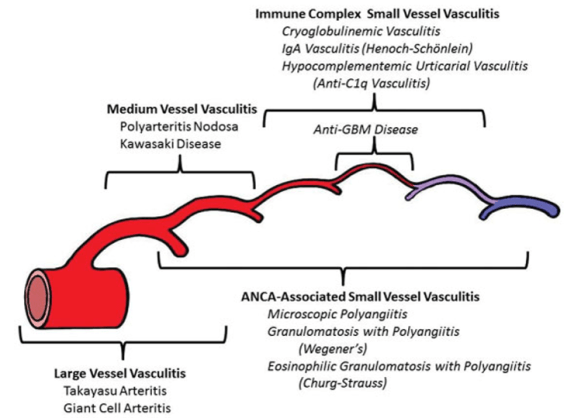 vasculitis.png