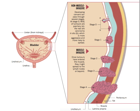 Staging bladder cancer