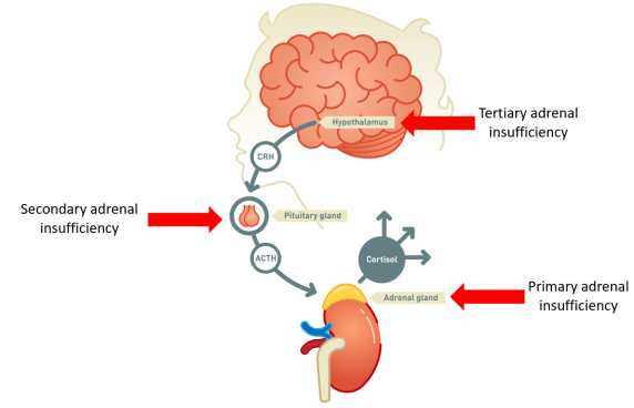 Adrenal insufficiency
