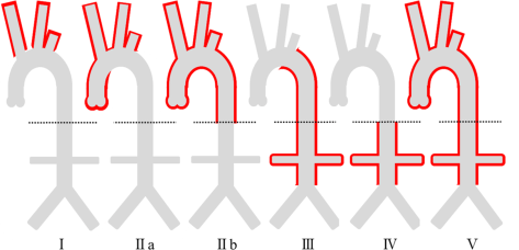 Angiographic classification of Takayasu